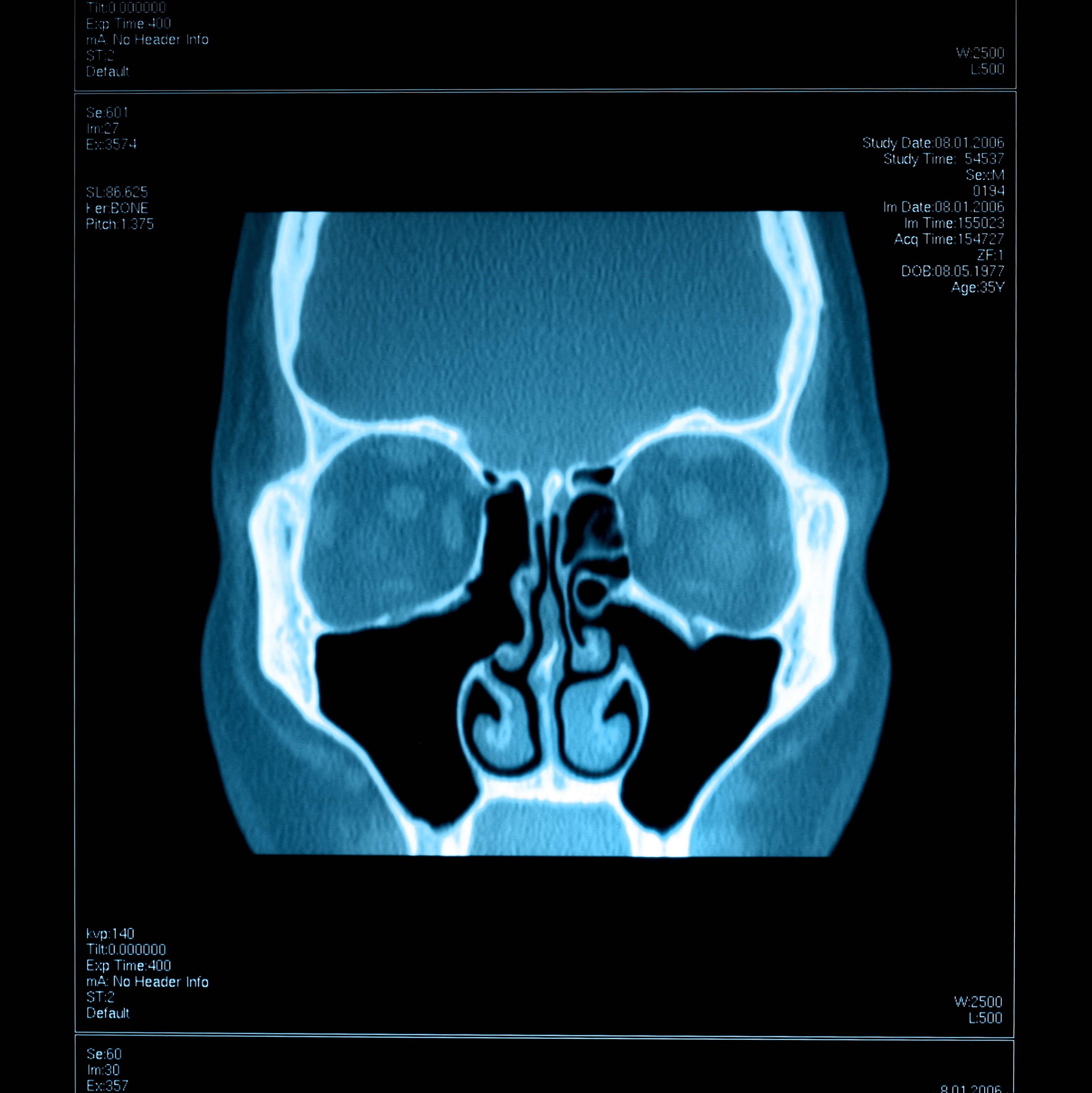 Sinuses On Ct Scan