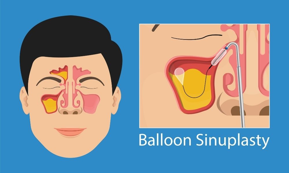 The Benefits of Balloon Sinuplasty Surgery